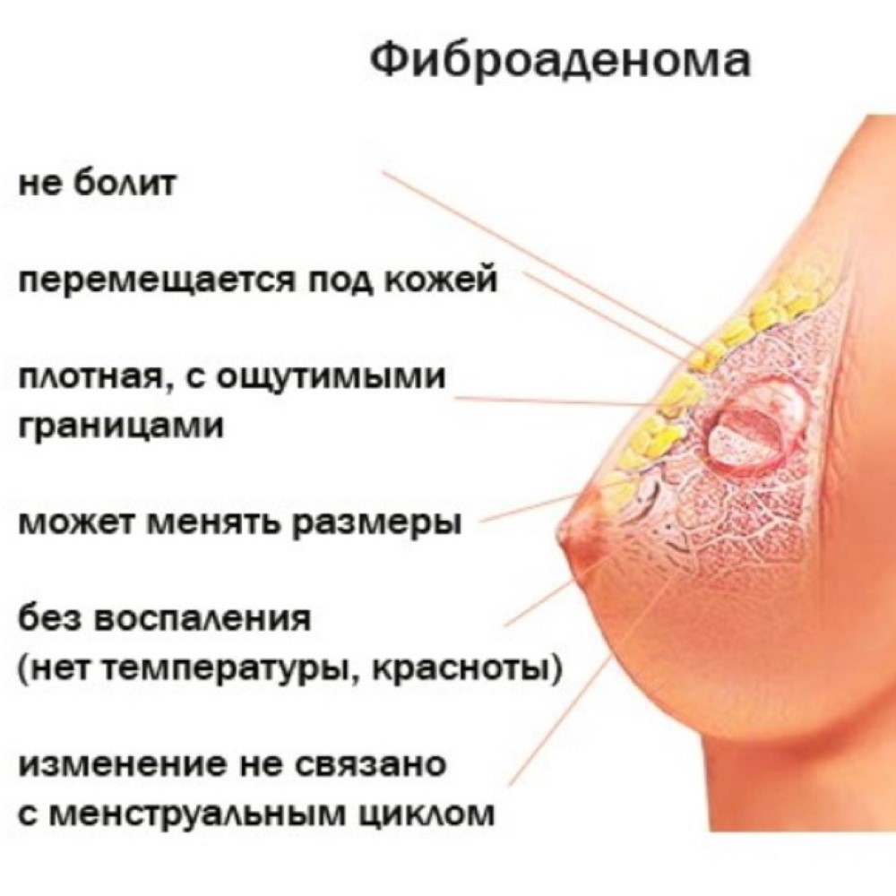 опухоль в районе груди у мужчин фото 97