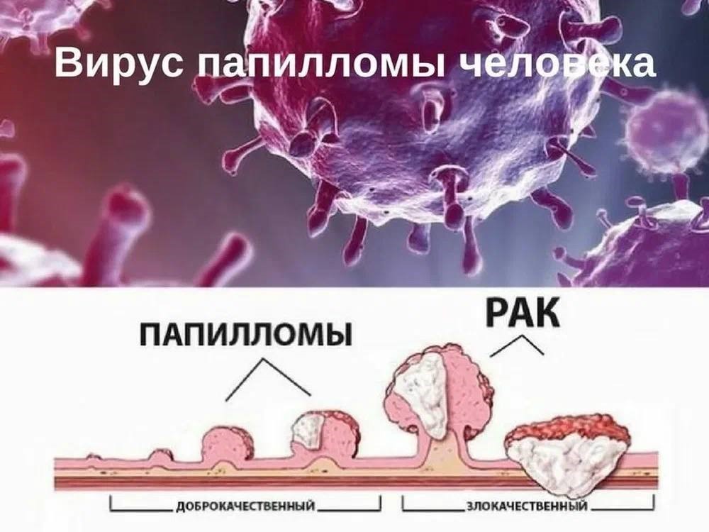 Лечение папилломы на половых органах Киев
