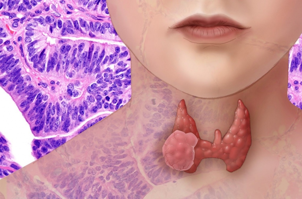 Узлы щитовидной железы: мифы и реальные опасности