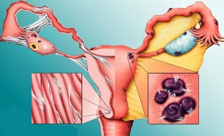 Наружный эндометриоз — симптомы, диагностика и лечение заболевания в Hadassah