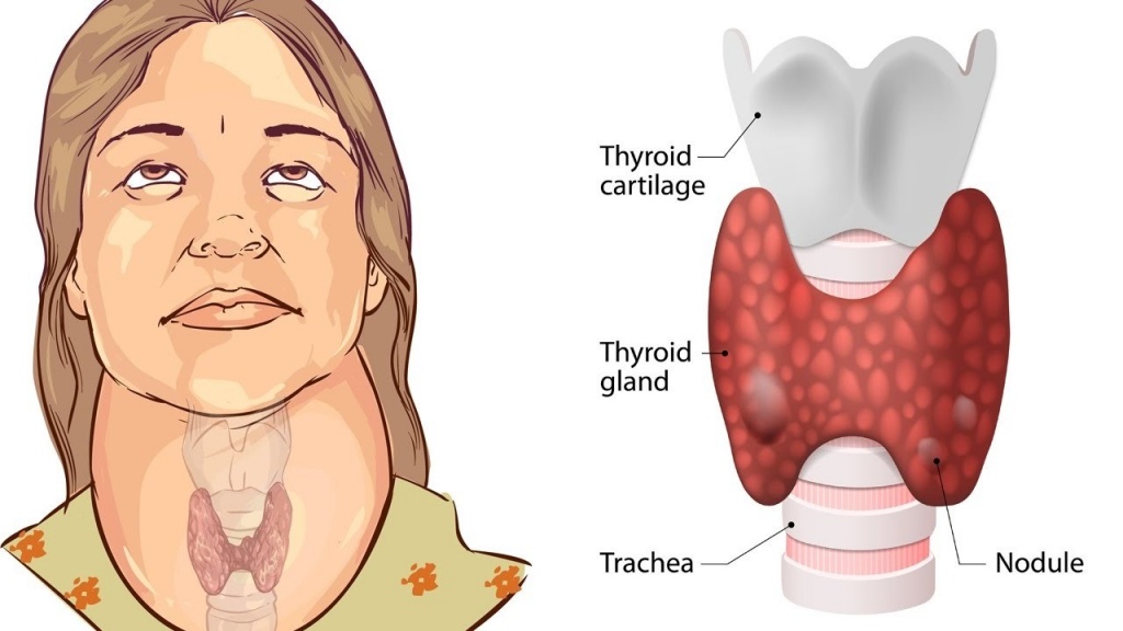 Узлы и кисты щитовидной железы - операция по удалению узлов щитовидки в СПб