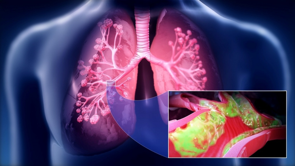 Хроническая обструктивная болезнь лёгких — Википедия