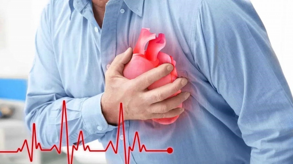 Острый инфаркт миокарда (ИМ)