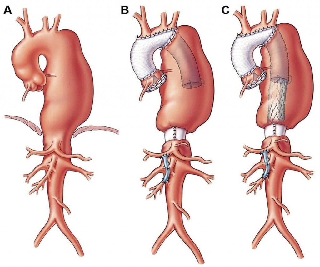 Аневризма аорты восходящего отдела, расширение аорты - лечение. Протезирование аорты в СПб
